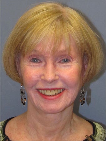 Neck Lift, Platysmaplasty after 634745