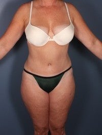 Tummy Tuck after 374140