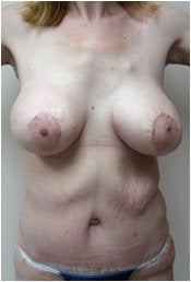 Body Lift after 205414