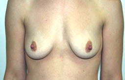 Breast Implants before 241826