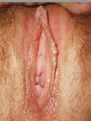 Labia Reduction Surgery after 100695