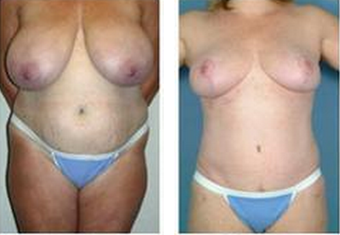 Mommy Makeover before 325029