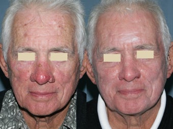 Fraxel repair in conjunction with multiple lasers before 104293