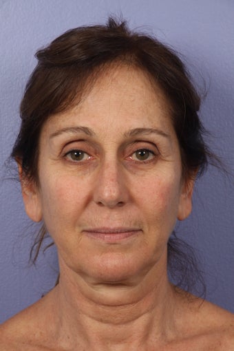 53 yr old Face and Necklift before 622092