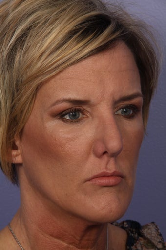 Botox after 333882
