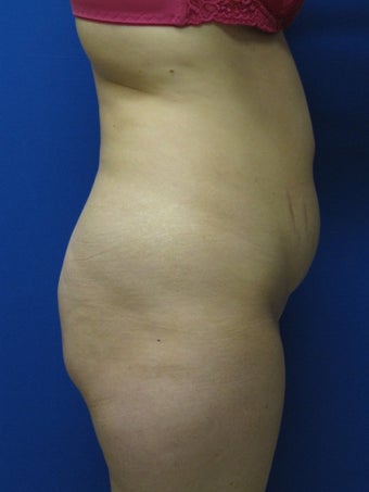 Abdominoplasty 343059
