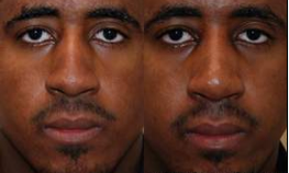 African-American Rhinoplasty before 115425