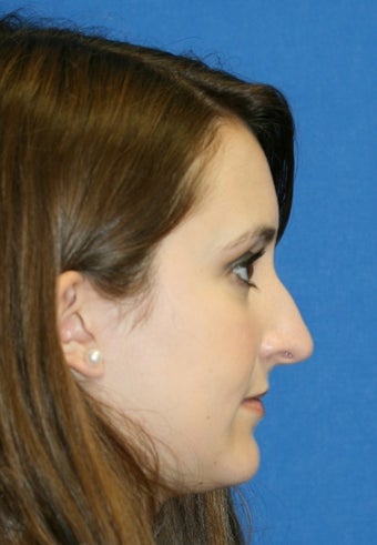 Rhinoplasty before 222677