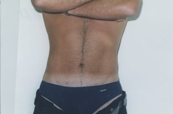 Liposuction after 211938