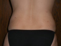 Liposuction after 272086