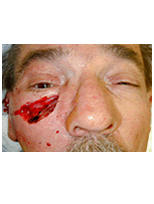 Sskin cancer reconstruction on the cheek before 84499