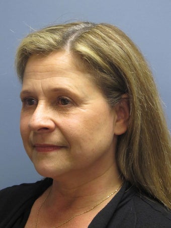 Neck Lift, Platysmaplasty 634725