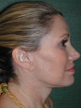 Female Facelift after 117062