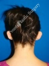 Ear Surgery (Otoplasty) before 616652