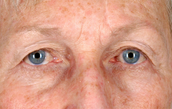 Upper Lid Blepharoplasty before 555133