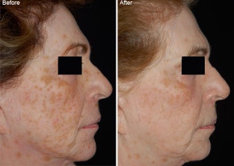 Fraxel Laser Resurfacing before 97773