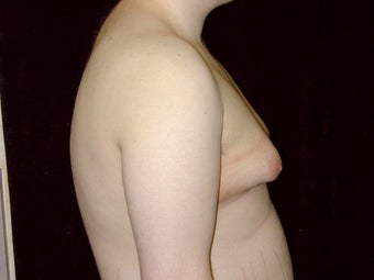 Gynecomastia Reduction Surgery before 238729