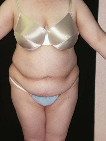 Tummy Tuck before 368682