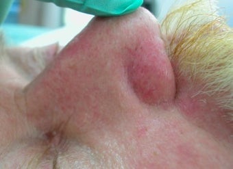 Vbeam for veins on nose after 374574