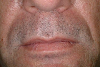 Evolence injections before 86803