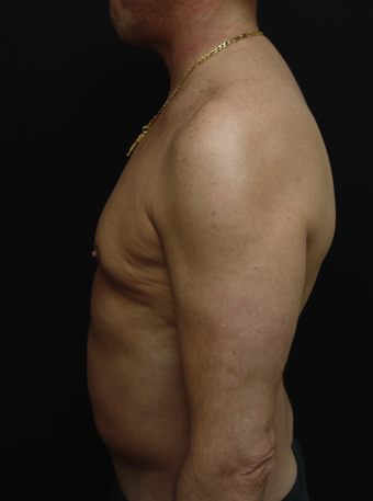 Tummy Liposuction after 230734