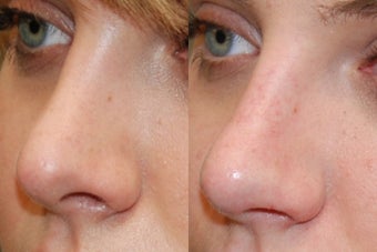Non-Surgical Rhinoplasty. 3/4 view. before 170673