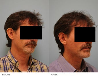 Otoplasty before 240161