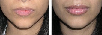 Lip Augmentation before 165799