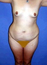 Tummy Tuck (Abdominoplasty), Mommy Makeover before 394835