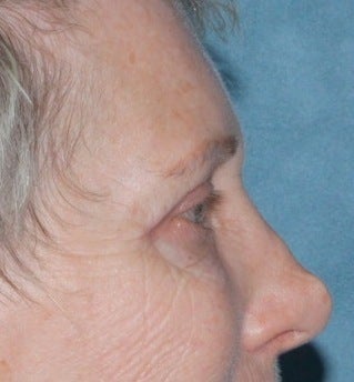 Laser resurfacing around eyes before 376160