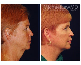 Facial Rejuvenation 395152