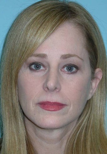 Full Facial Rejuvenation and Rhinoplasty after 182367