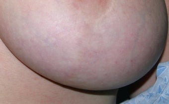 Breast implant scar removal after 376097