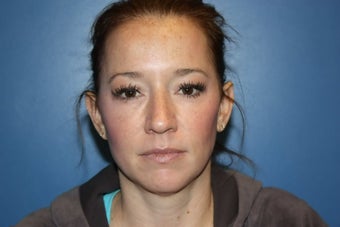 BBL and MLP Laser treatment for hyperpigmentation before 536246