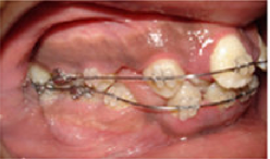 Braces and Extraction before 349088