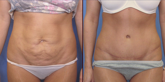 Abdominoplasty before 239132