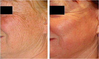 CO2 Laser Resurfacing ~ ActiveFX & DeepFX before 166170