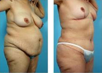Mommy Makeover after 325020