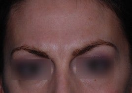 Botox before 555510