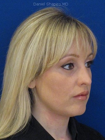 Bilateral Upper Blepharoplasty and Lower Blepharoplasty with TCA Chemical Peel, performed in the office under oral sedation w after 249709