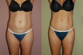 Tummy Tuck 368140