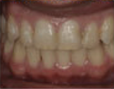 Damon System Braces 477176