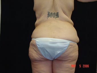 Body Lift, Outer Thigh Lift, Buttocks Lift before 203467