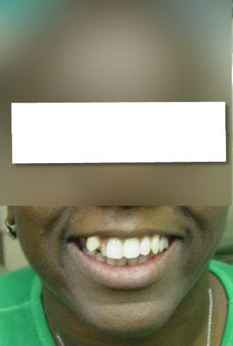 Invisalign before 437118