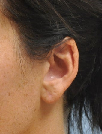Ear Lobe Repair after 602967