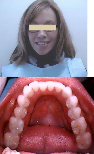 Invisalign before 109486
