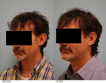 Otoplasty after 240160
