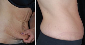 Full Tummy Tuck before 478949