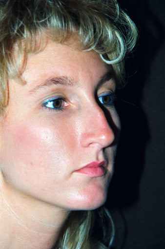 Rhinoplasty (nose job) before 235829