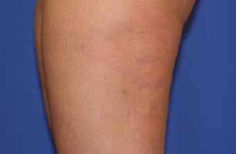 VASER Shape to Legs after 433064
